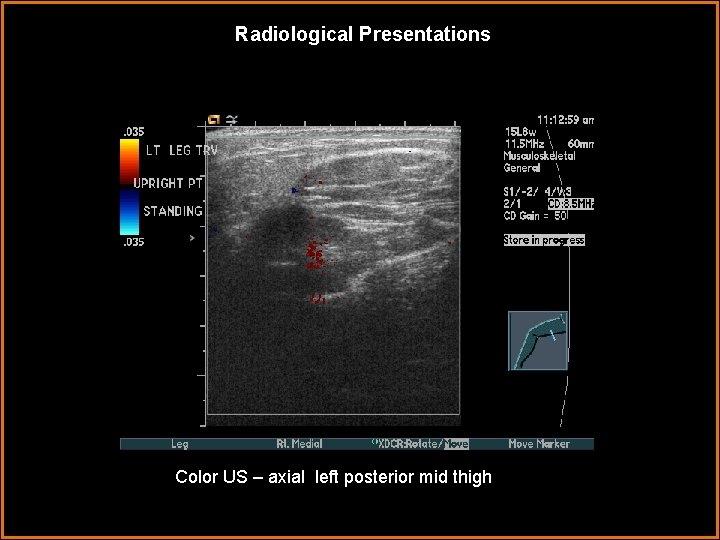 Radiological Presentations Color US – axial left posterior mid thigh 