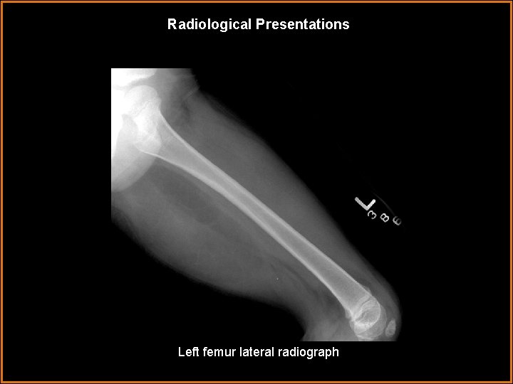 Radiological Presentations Left femur lateral radiograph 