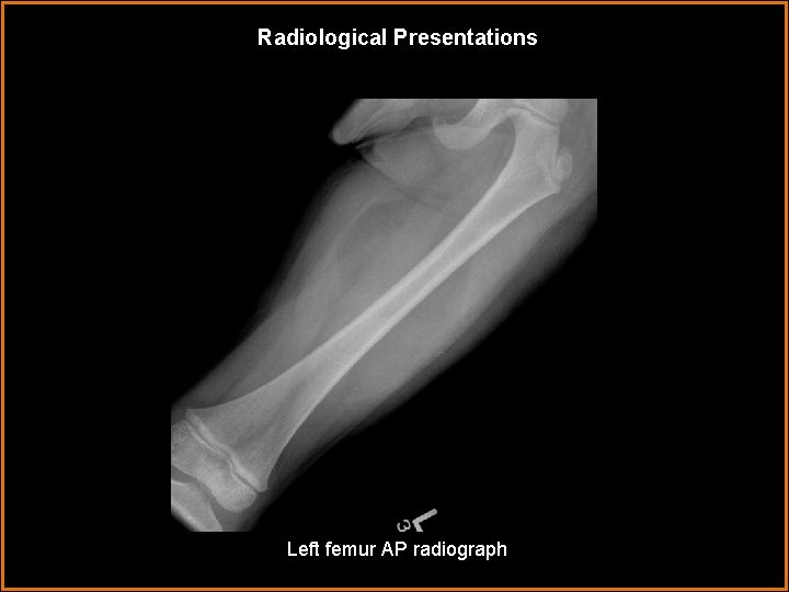 Radiological Presentations Left femur AP radiograph 