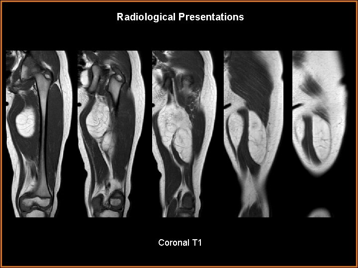 Radiological Presentations Coronal T 1 