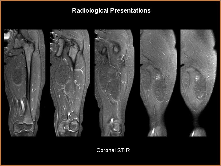 Radiological Presentations Coronal STIR 