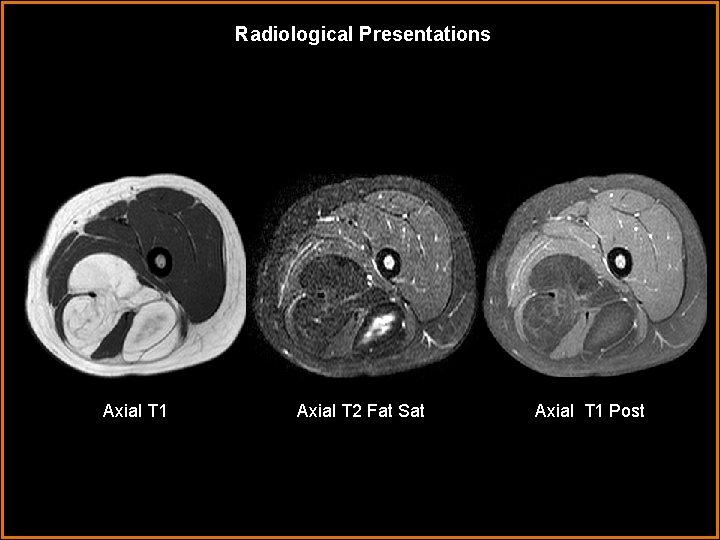 Radiological Presentations Axial T 1 Axial T 2 Fat Sat Axial T 1 Post