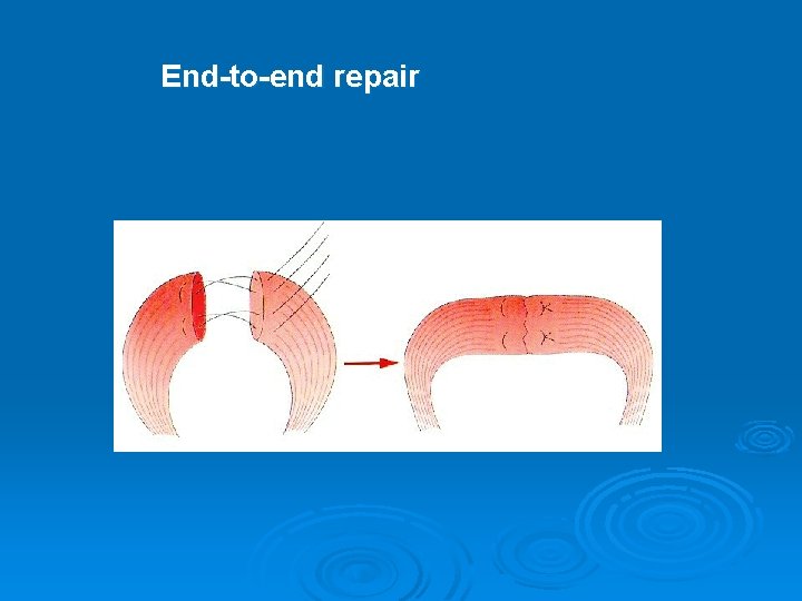 End-to-end repair 