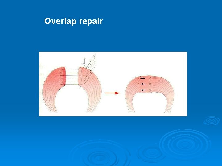 Overlap repair 