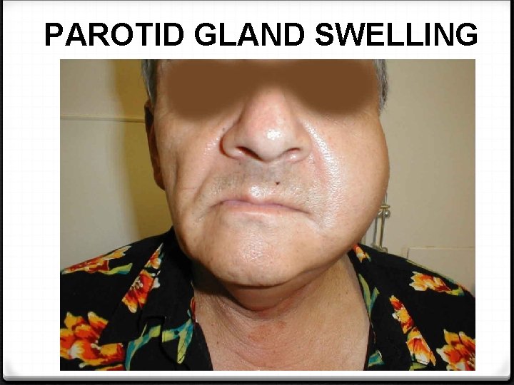 PAROTID GLAND SWELLING 