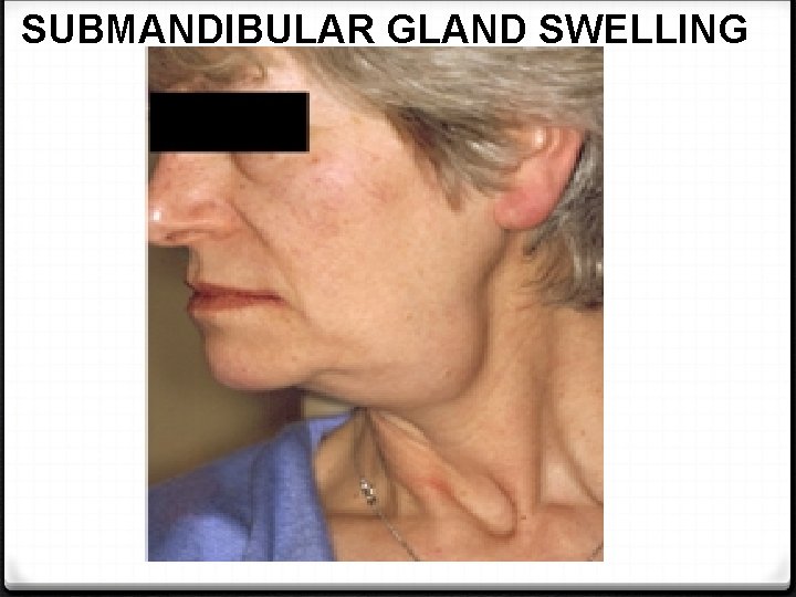 SUBMANDIBULAR GLAND SWELLING 