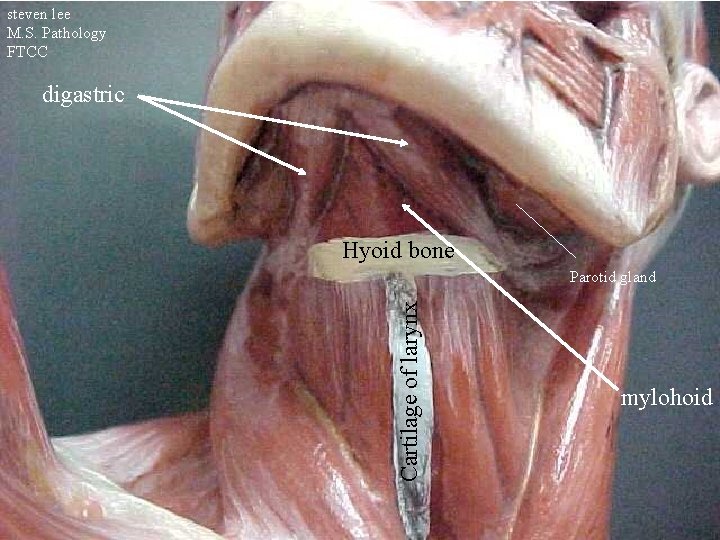 steven lee M. S. Pathology FTCC digastric Hyoid bone Cartilage of larynx Parotid gland