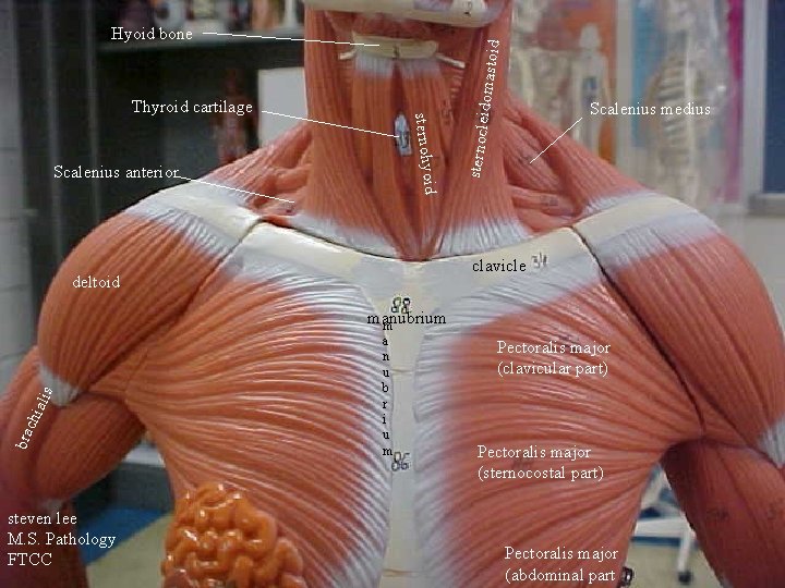 Scalenius anterior Scalenius medius sternocle sternohyoi Thyroid cartilage idomasto id Hyoid bone d clavicle