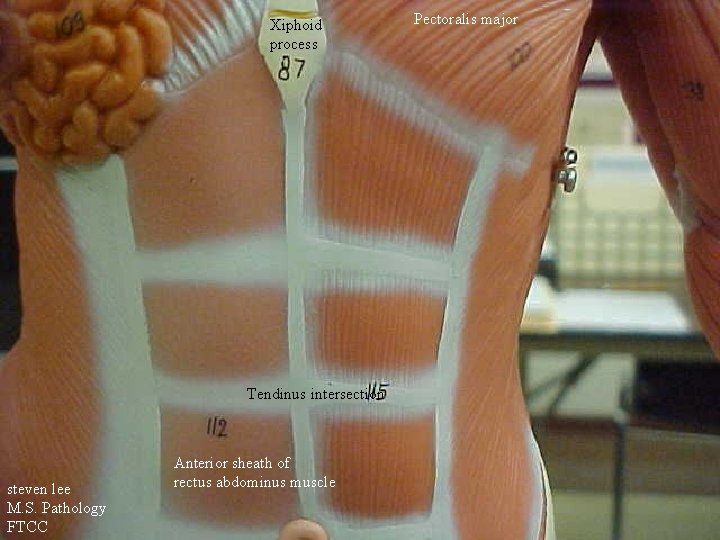 Xiphoid process Tendinus intersection steven lee M. S. Pathology FTCC Anterior sheath of rectus