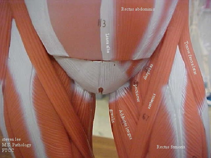 us pectine s soa s latae ilio p scia or fa Tens Linea alba