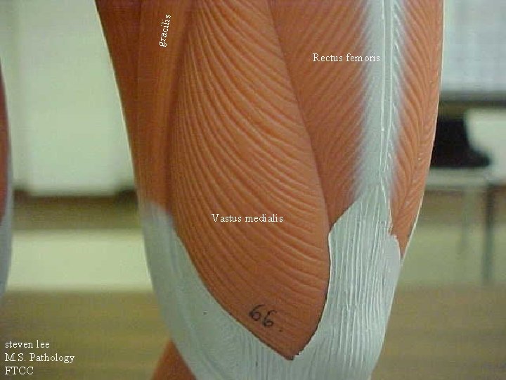 s gracili Rectus femoris Vastus medialis steven lee M. S. Pathology FTCC 