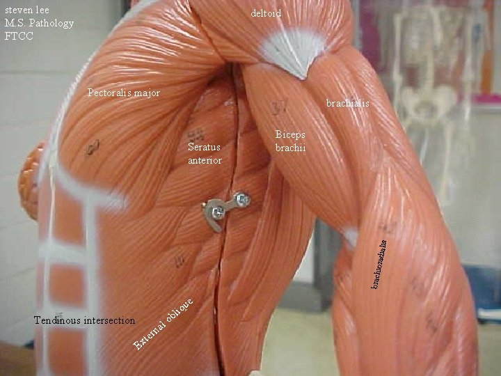 steven lee M. S. Pathology FTCC deltoid Pectoralis major brachialis brachio radialis Seratus anterior