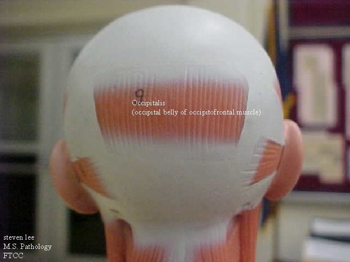 Occipitalis (occipital belly of occipitofrontal muscle) steven lee M. S. Pathology FTCC 