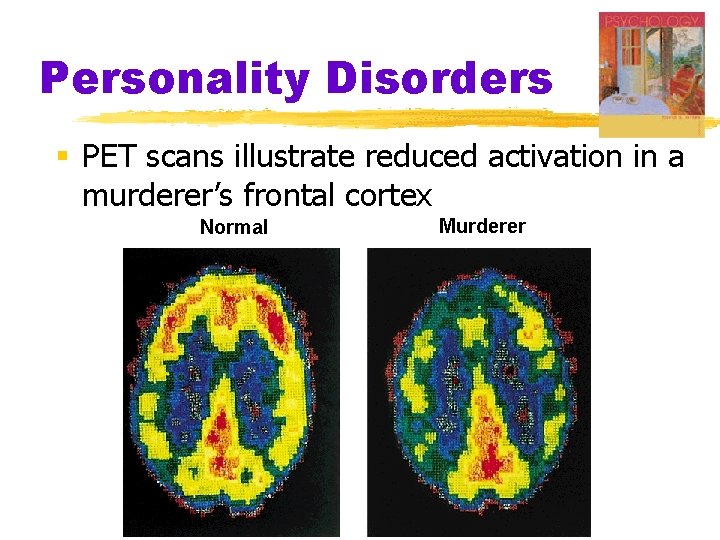 Personality Disorders § PET scans illustrate reduced activation in a murderer’s frontal cortex Normal