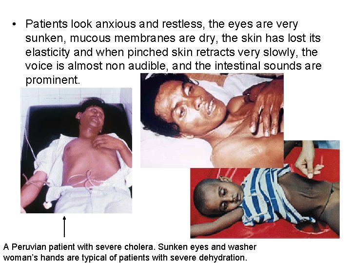  • Patients look anxious and restless, the eyes are very sunken, mucous membranes