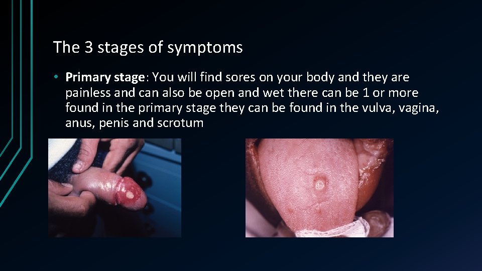 The 3 stages of symptoms • Primary stage: You will find sores on your