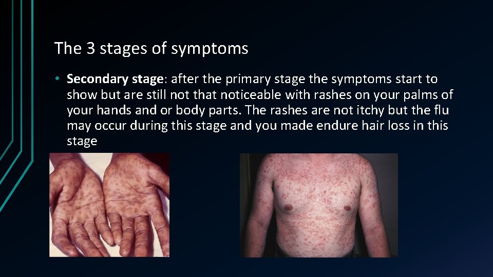 The 3 stages of symptoms • Secondary stage: after the primary stage the symptoms