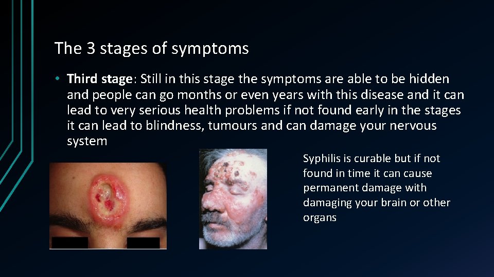 The 3 stages of symptoms • Third stage: Still in this stage the symptoms
