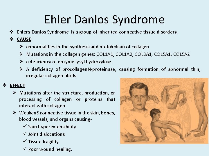 Ehler Danlos Syndrome v Ehlers-Danlos Syndrome is a group of inherited connective tissue disorders.