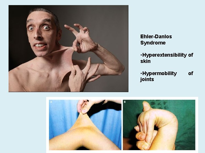 Ehler-Danlos Syndrome • Hyperextensibility of skin • Hypermobility joints of 