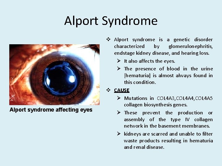 Alport Syndrome Alport syndrome affecting eyes v Alport syndrome is a genetic disorder characterized