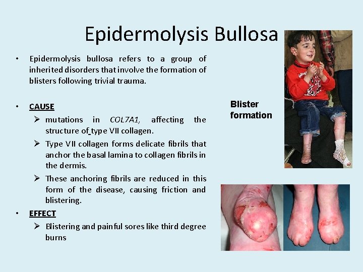 Epidermolysis Bullosa • Epidermolysis bullosa refers to a group of inherited disorders that involve