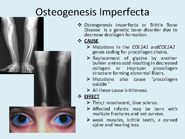 Osteogenesis Imperfecta v Osteogenesis imperfecta or Brittle Bone Disease is a genetic bone disorder