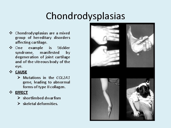 Chondrodysplasias v Chondrodysplasias are a mixed group of hereditary disorders affecting cartilage. v One