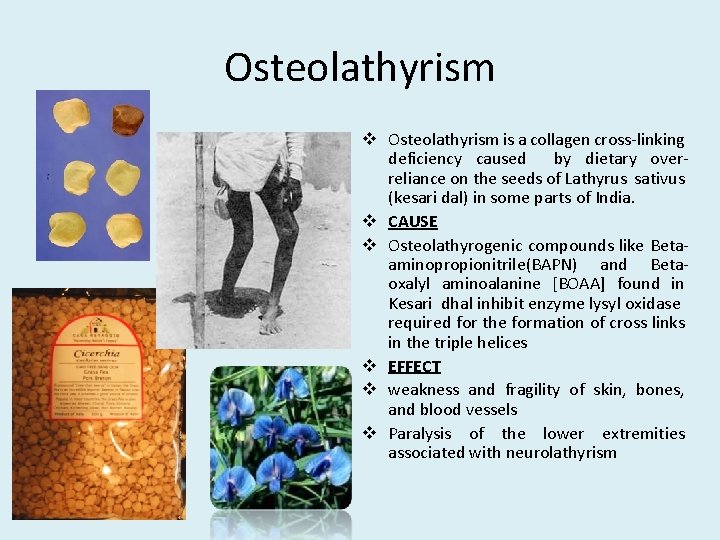 Osteolathyrism v Osteolathyrism is a collagen cross-linking deficiency caused by dietary overreliance on the