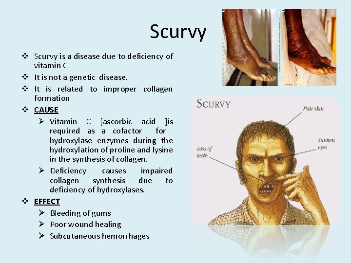 Scurvy v Scurvy is a disease due to deficiency of vitamin C v It