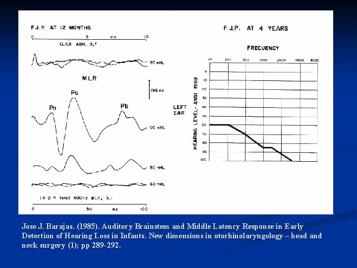 Jose J. Barajas. (1985). Auditory Brainstem and Middle Latency Response in Early Detection of