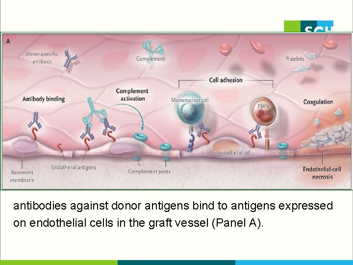 antibodies against donor antigens bind to antigens expressed on endothelial cells in the graft