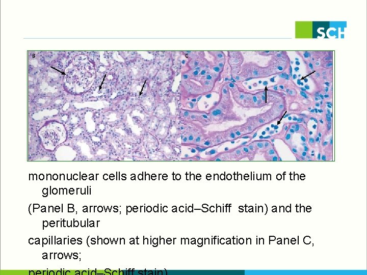 mononuclear cells adhere to the endothelium of the glomeruli (Panel B, arrows; periodic acid–Schiff