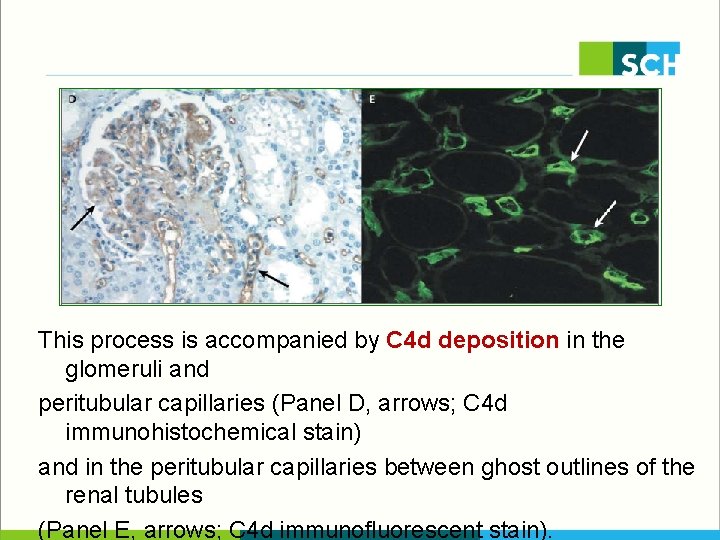 This process is accompanied by C 4 d deposition in the glomeruli and peritubular