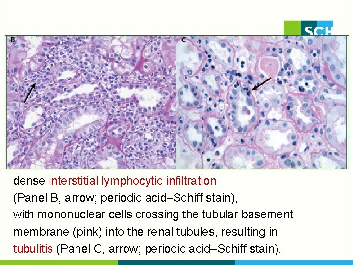 dense interstitial lymphocytic infiltration (Panel B, arrow; periodic acid–Schiff stain), with mononuclear cells crossing