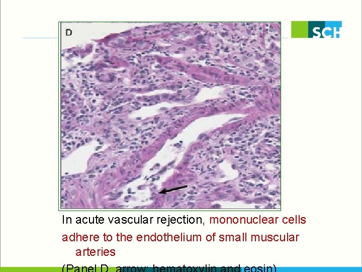 In acute vascular rejection, mononuclear cells adhere to the endothelium of small muscular arteries