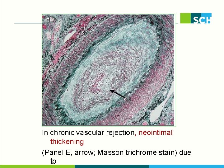 In chronic vascular rejection, neointimal thickening (Panel E, arrow; Masson trichrome stain) due to