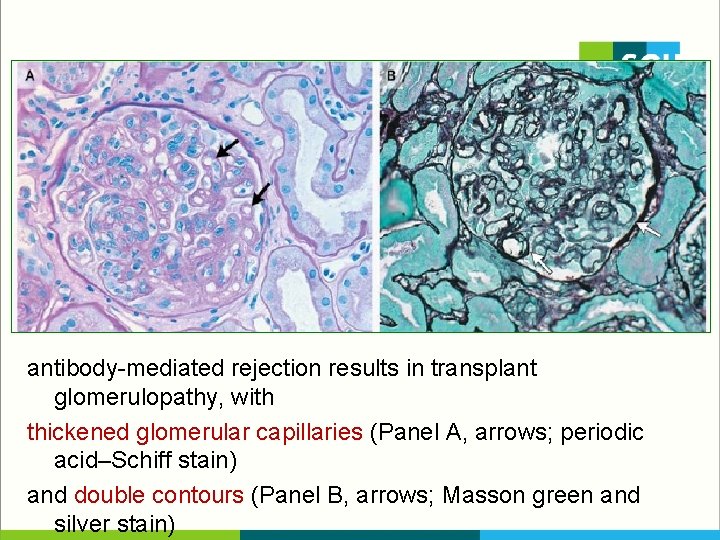 antibody-mediated rejection results in transplant glomerulopathy, with thickened glomerular capillaries (Panel A, arrows; periodic