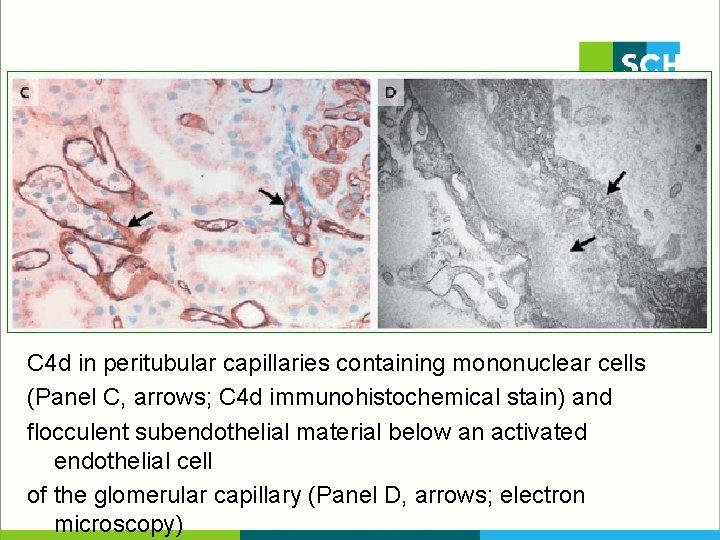 C 4 d in peritubular capillaries containing mononuclear cells (Panel C, arrows; C 4