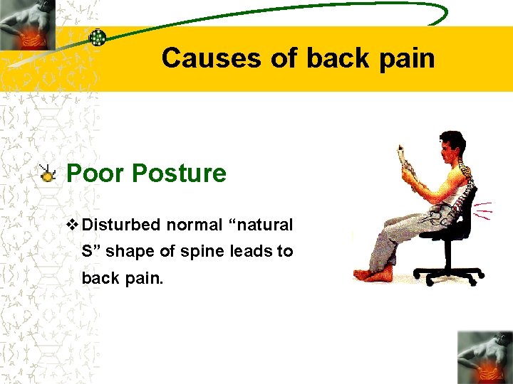 Causes of back pain Poor Posture v. Disturbed normal “natural S” shape of spine