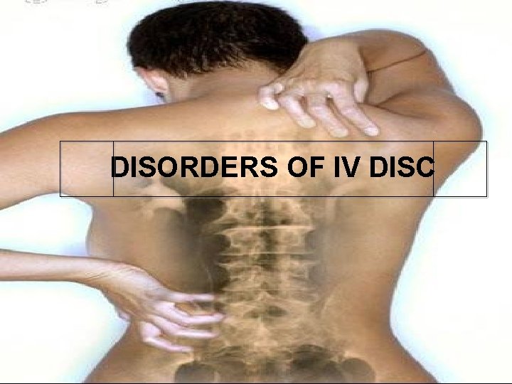 DISORDERS OF IV DISC 