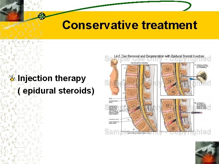 Conservative treatment Injection therapy ( epidural steroids) 