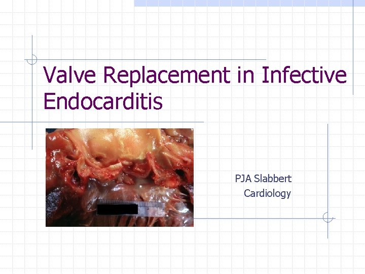 Valve Replacement in Infective Endocarditis PJA Slabbert Cardiology 