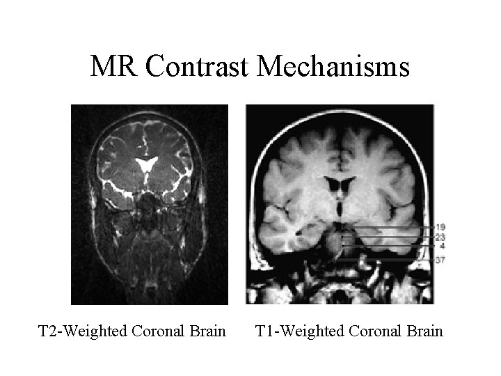 MR Contrast Mechanisms T 2 -Weighted Coronal Brain T 1 -Weighted Coronal Brain 