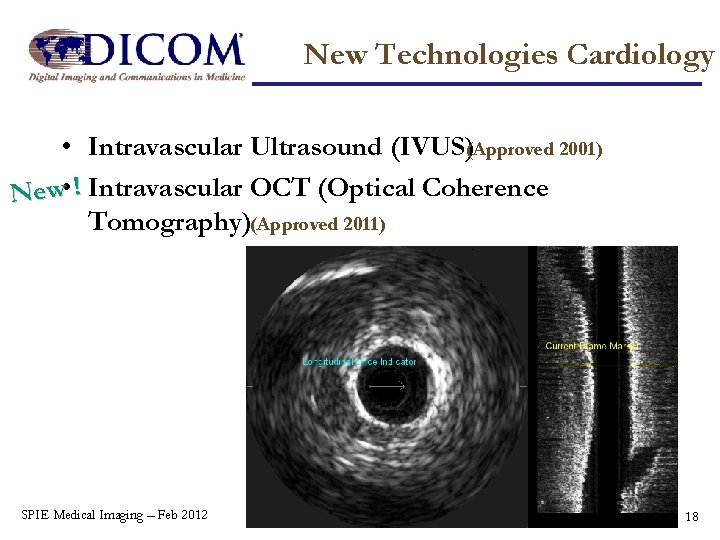 New Technologies Cardiology • Intravascular Ultrasound (IVUS)(Approved 2001) New • ! Intravascular OCT (Optical