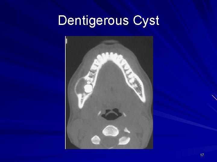 Dentigerous Cyst 17 