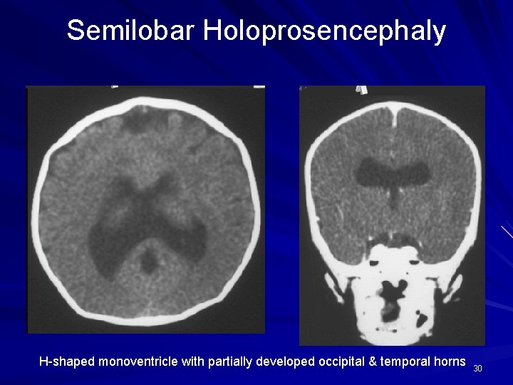 Semilobar Holoprosencephaly H-shaped monoventricle with partially developed occipital & temporal horns 30 