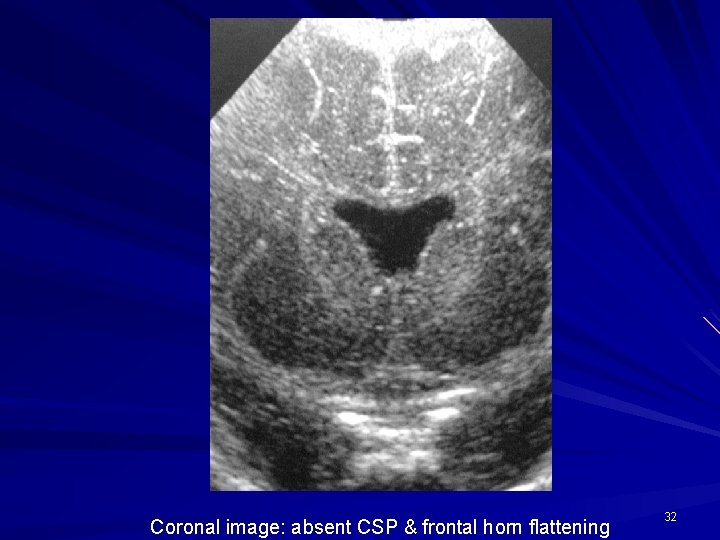 Coronal image: absent CSP & frontal horn flattening 32 