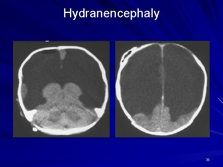 Hydranencephaly 36 