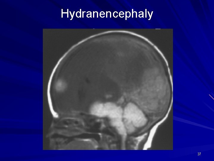 Hydranencephaly 37 